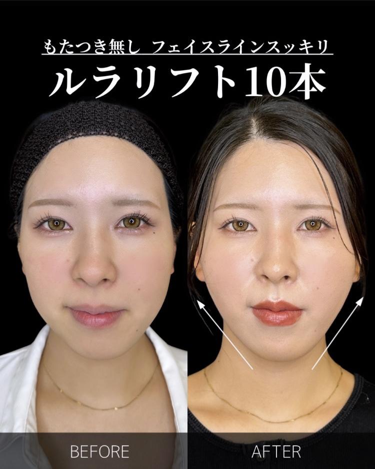 ルラリフトの症例写真