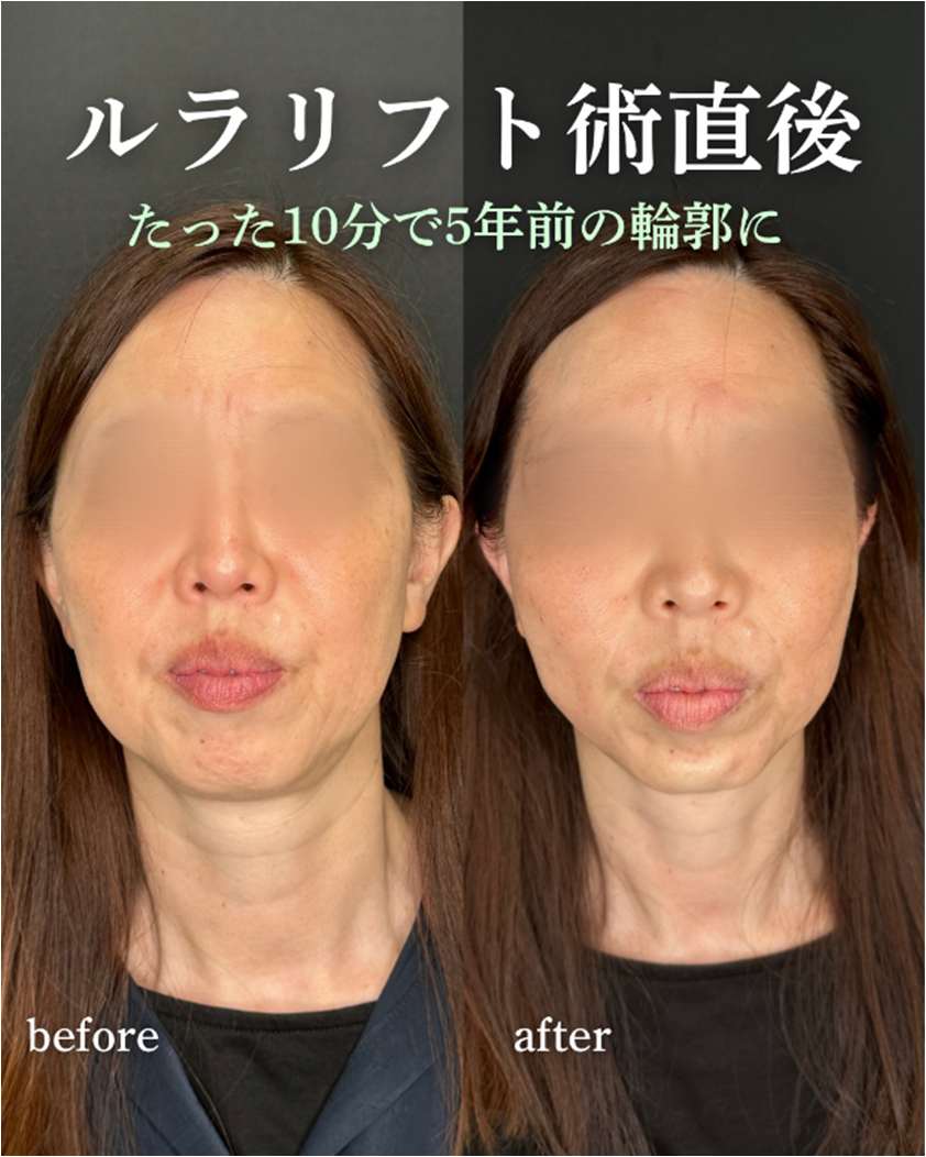 ルラリフトの症例写真