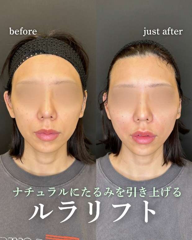 ルラリフトの症例写真