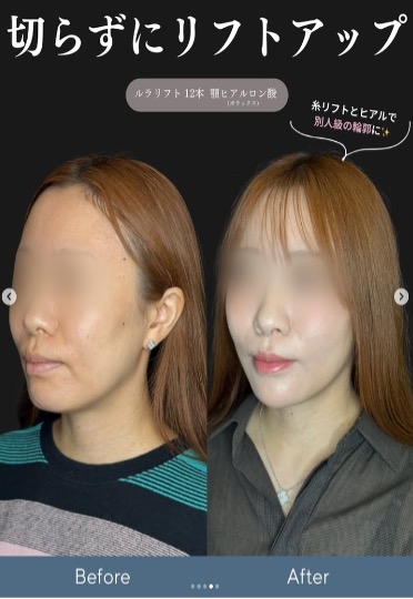 ルラリフトの症例写真