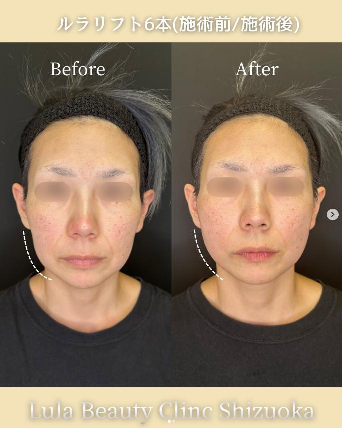 ルラリフトの症例写真