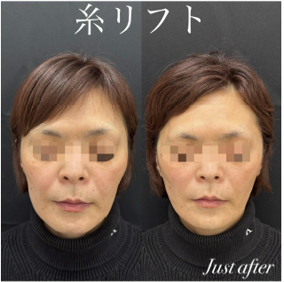 ルラリフトの症例写真