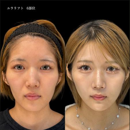 ルラリフトの症例写真