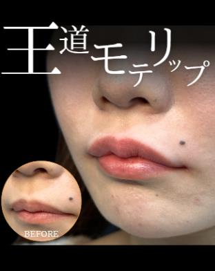唇のヒアルロン酸注入の症例写真