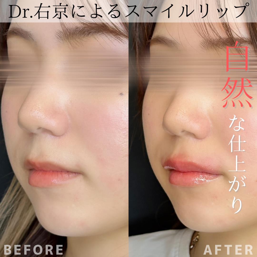 スマイルリップの症例写真