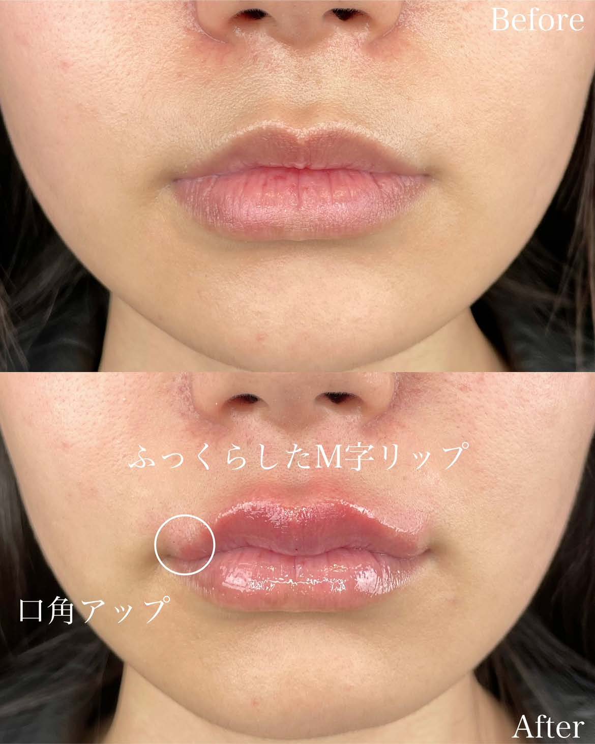 スマイルリップの症例写真
