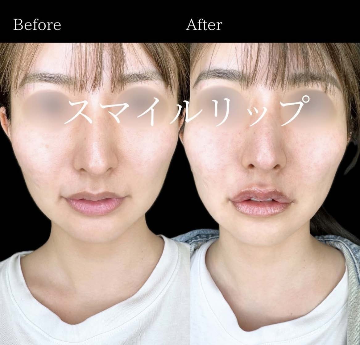 スマイルリップの症例写真