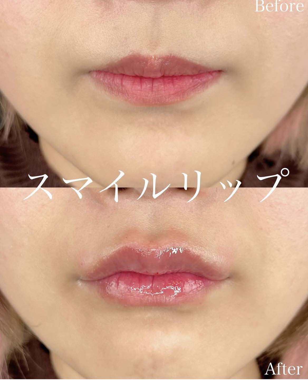 スマイルリップの症例写真