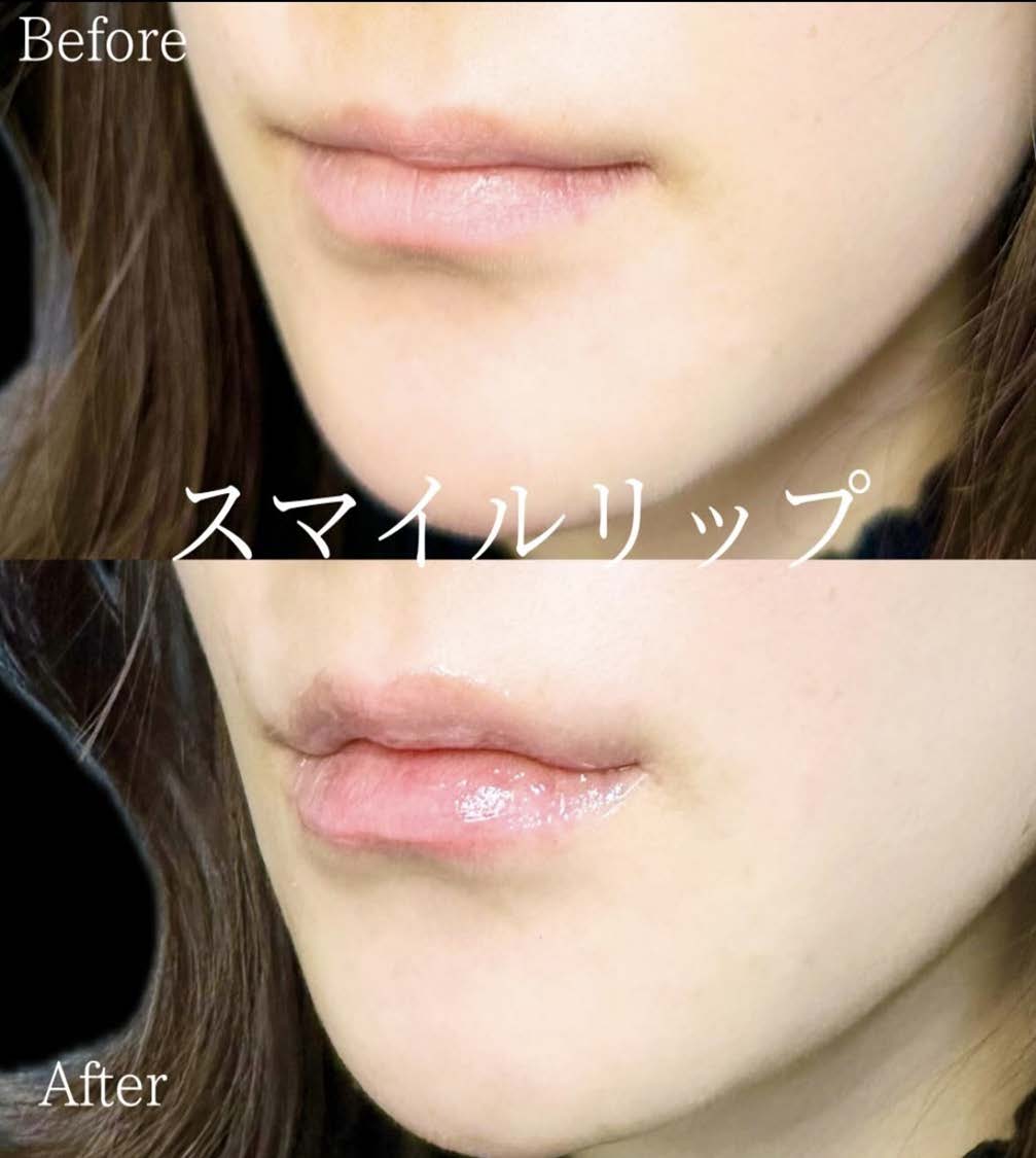 スマイルリップの症例写真