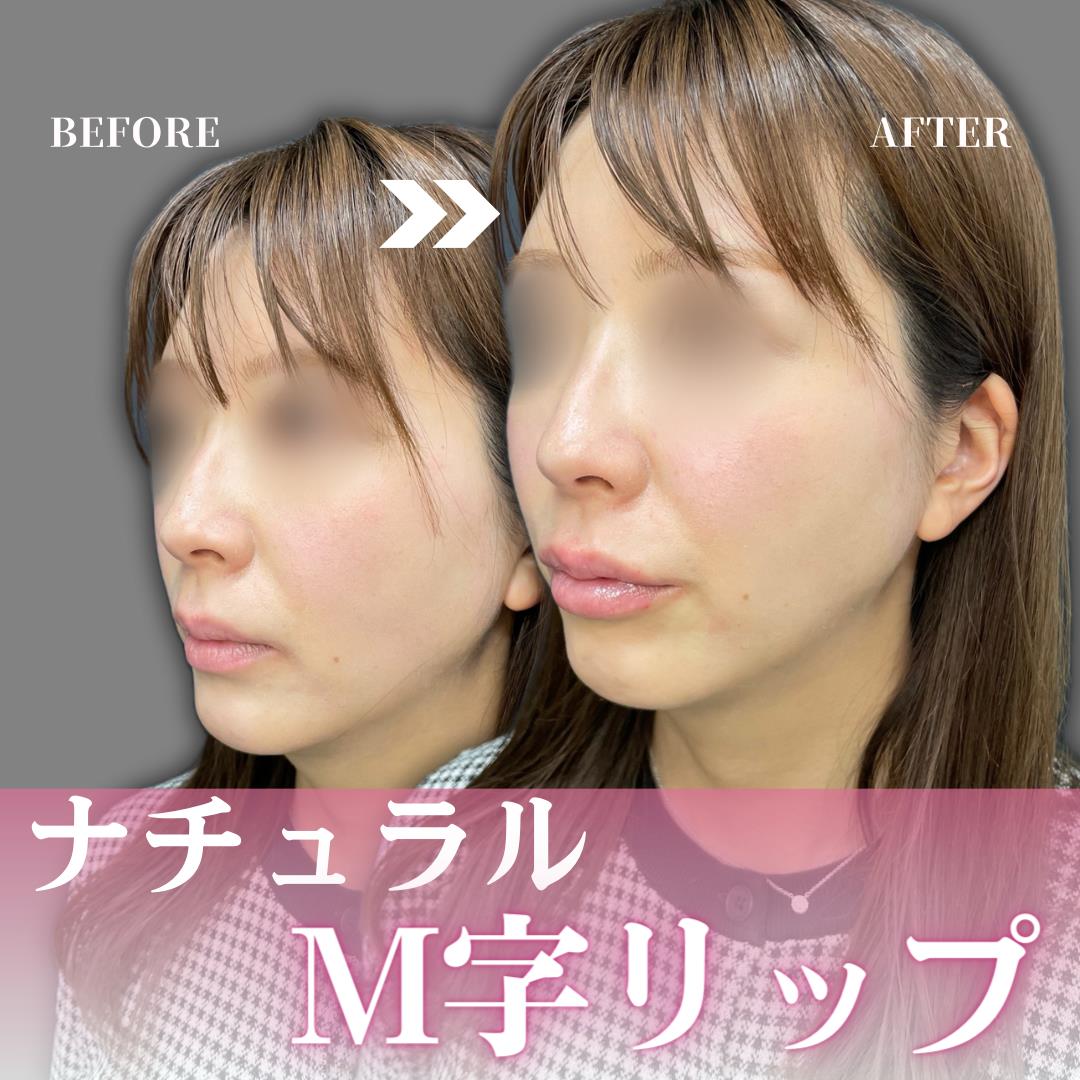 スマイルリップの症例写真