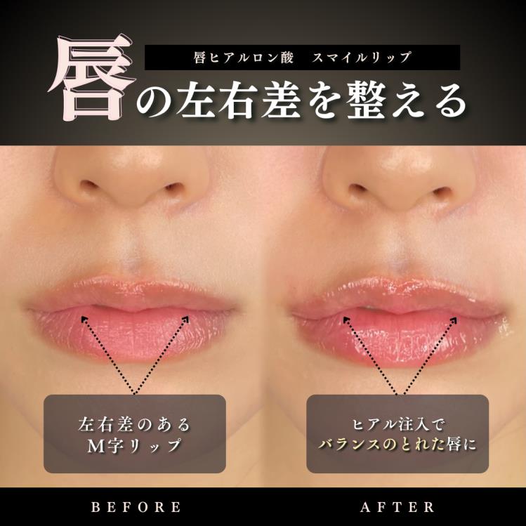 スマイルリップの症例写真