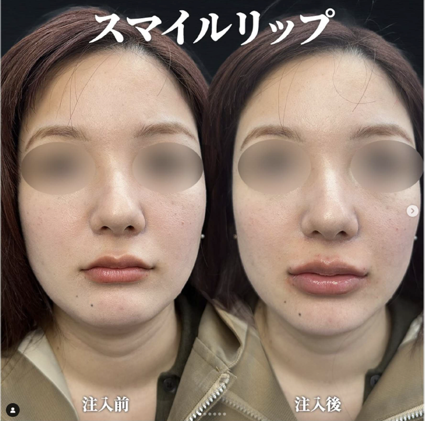 スマイルリップの症例写真