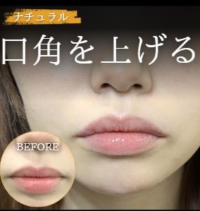 スマイルリップの症例写真
