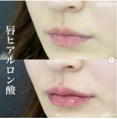 Cカールリップの症例写真