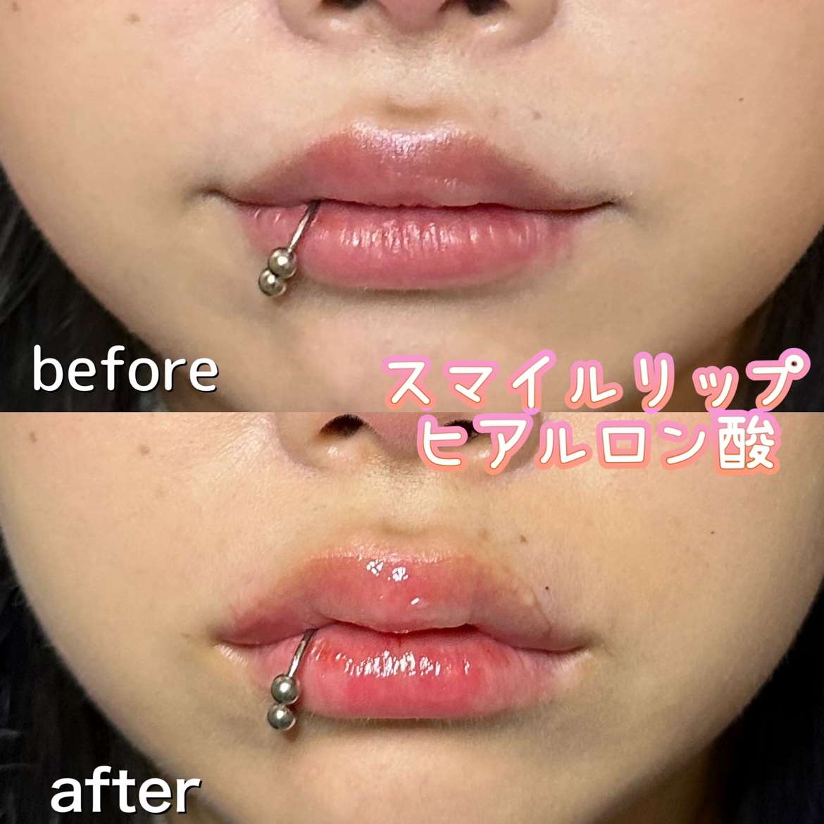 Cカールリップの症例写真