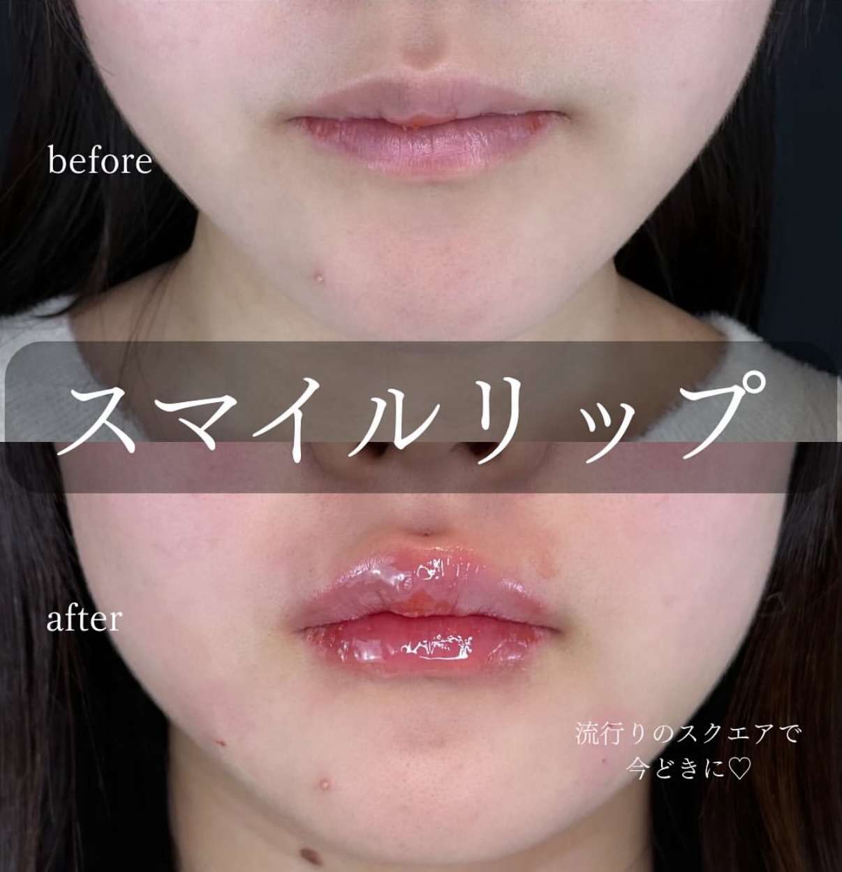 Cカールリップの症例写真