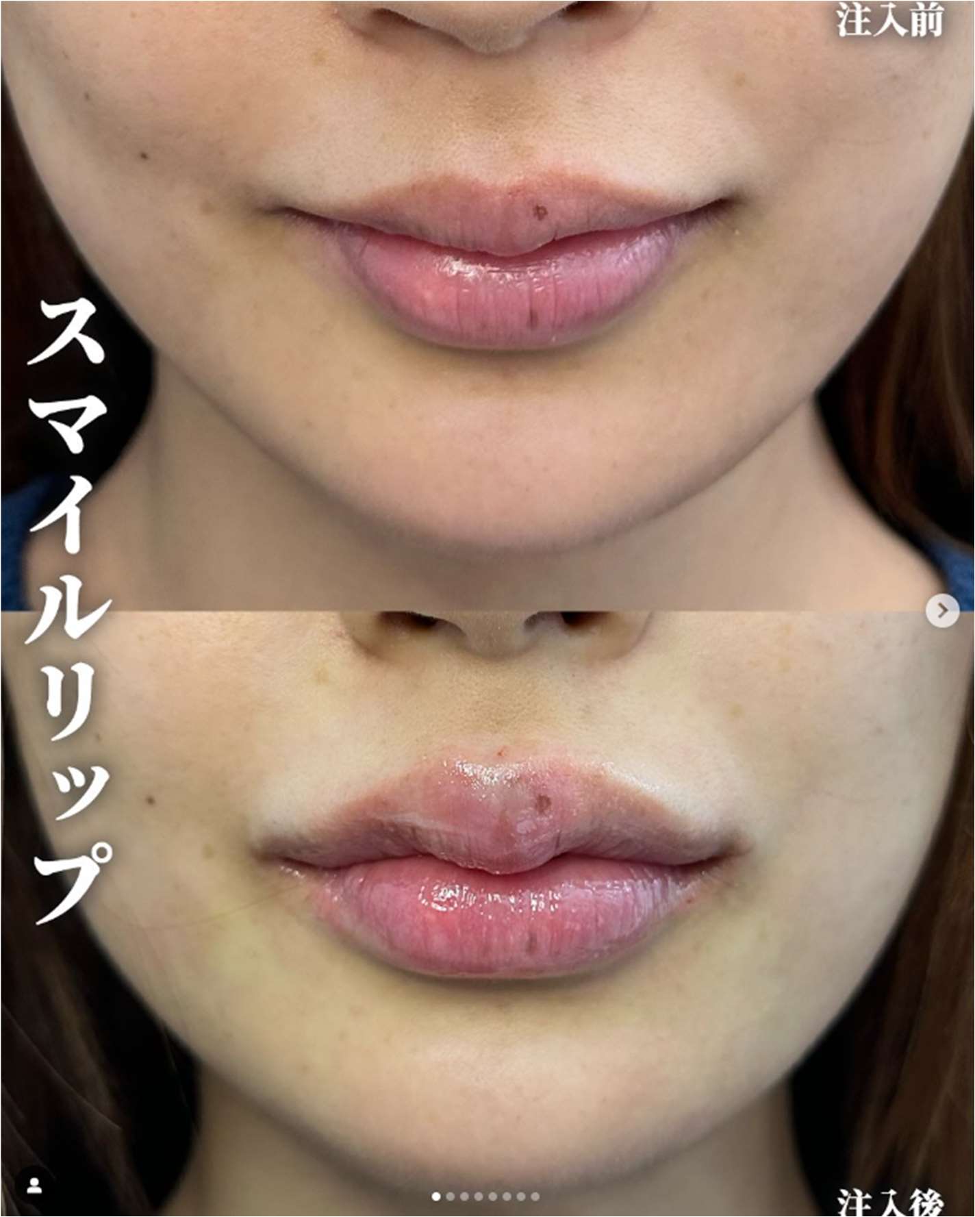 Cカールリップの症例写真