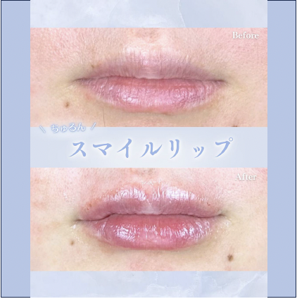 Cカールリップの症例写真