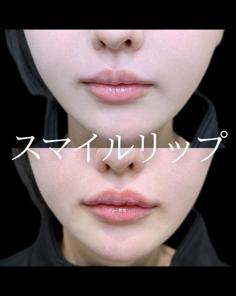 Cカールリップの症例写真