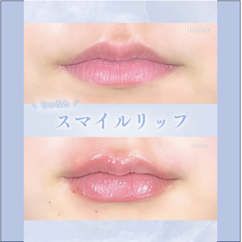 Ｃカールリップの症例写真