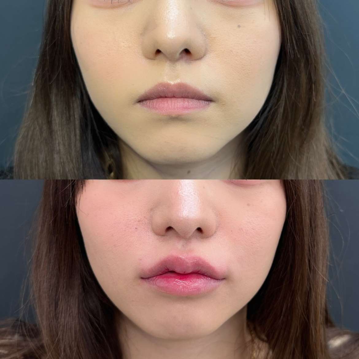 Ｃカールリップの症例写真