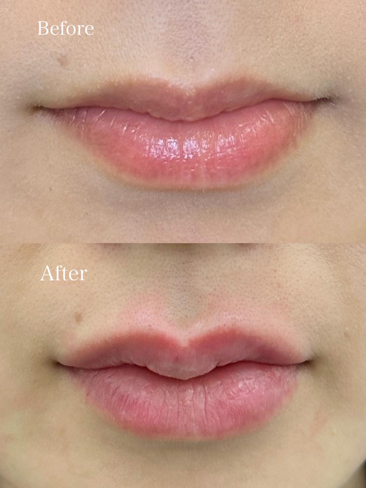 Ｃカールリップの症例写真