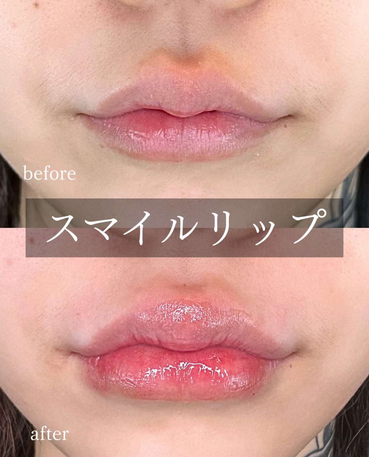 Ｃカールリップの症例写真