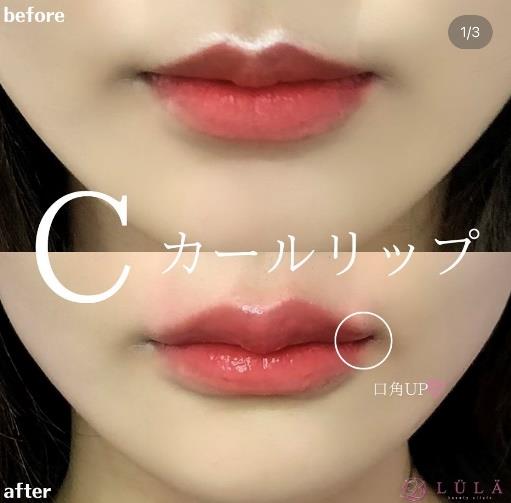 Cカールリップの症例写真
