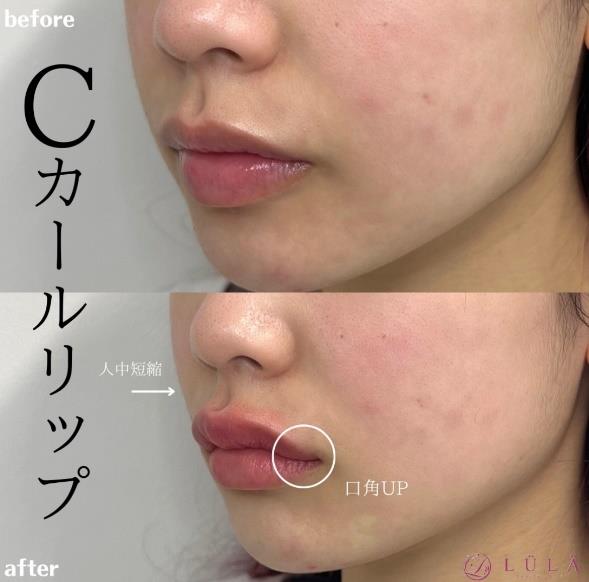 Cカールリップの症例写真