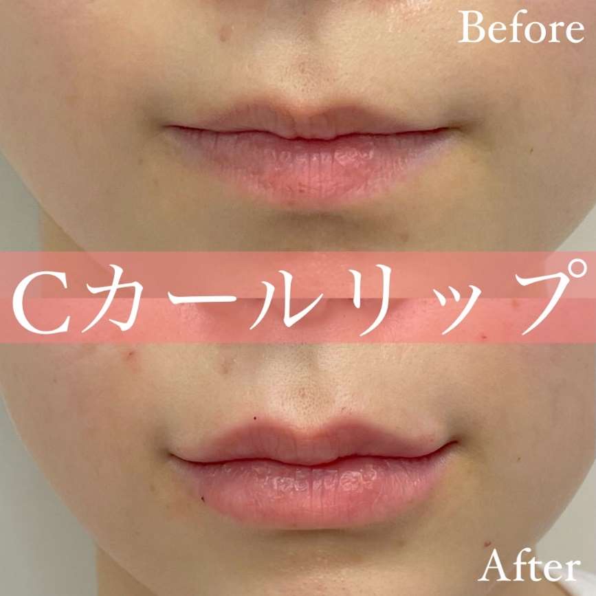 Cカールリップの症例写真