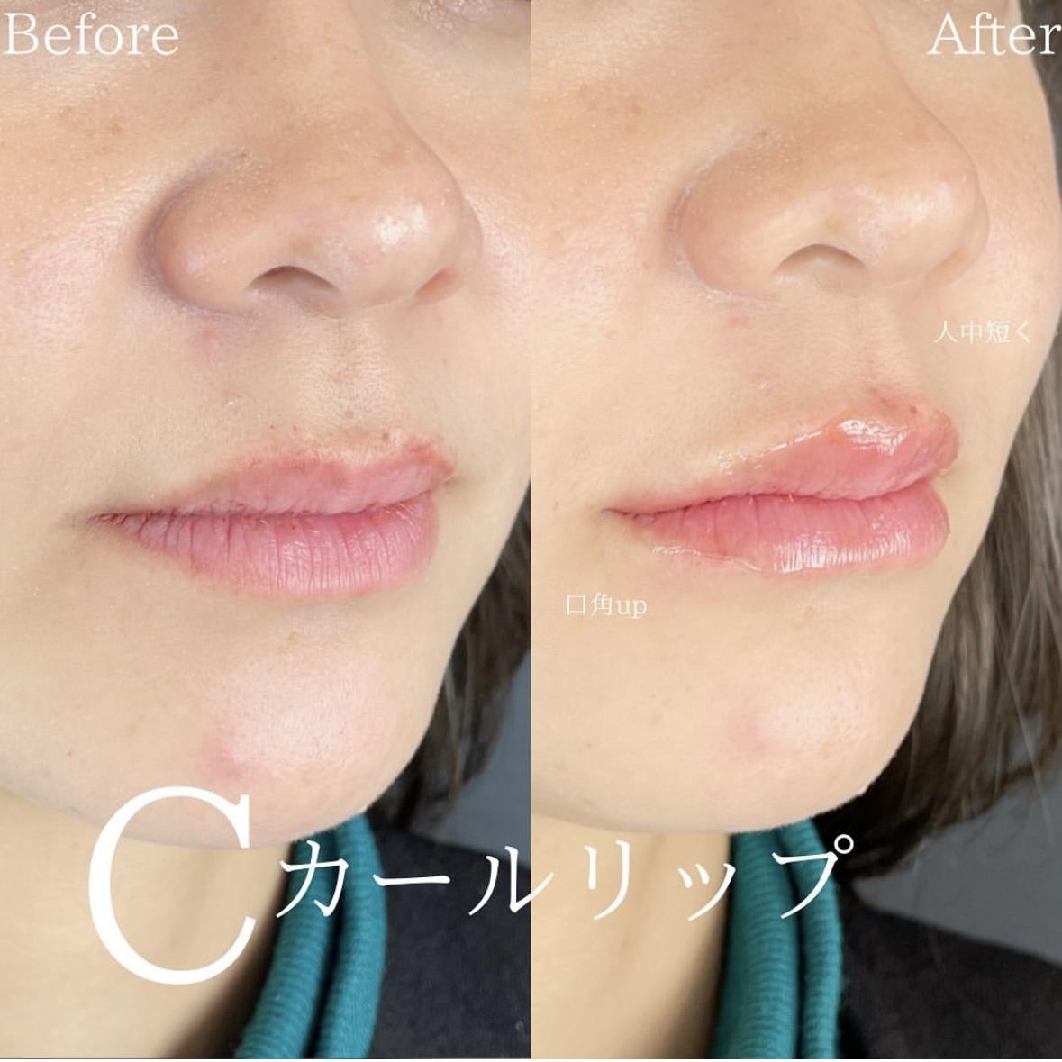 Cカールリップの症例写真