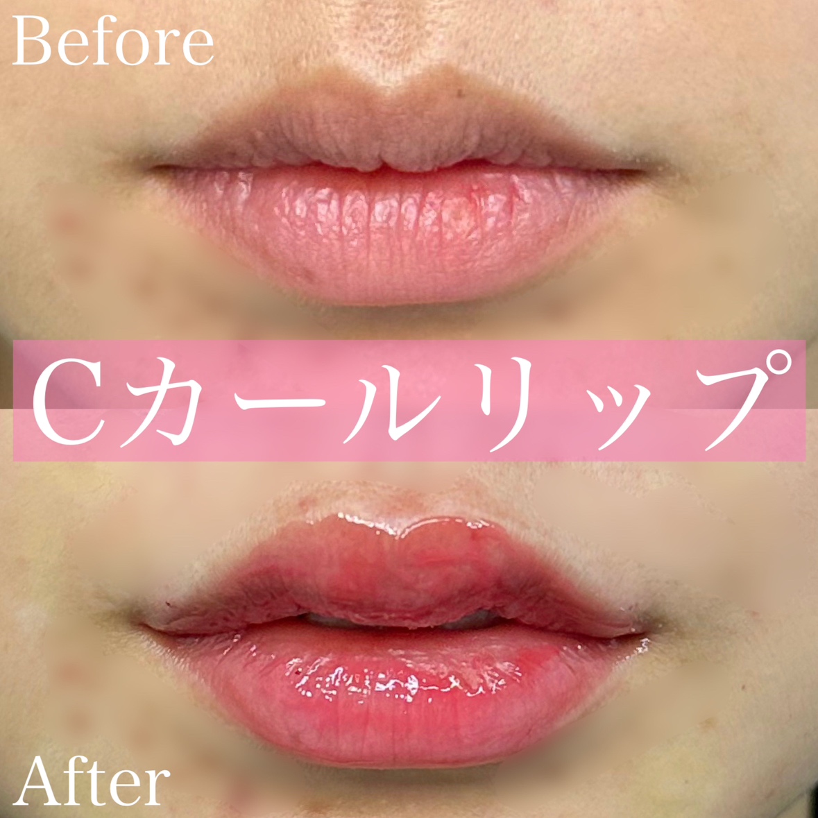 Cカールリップの症例写真