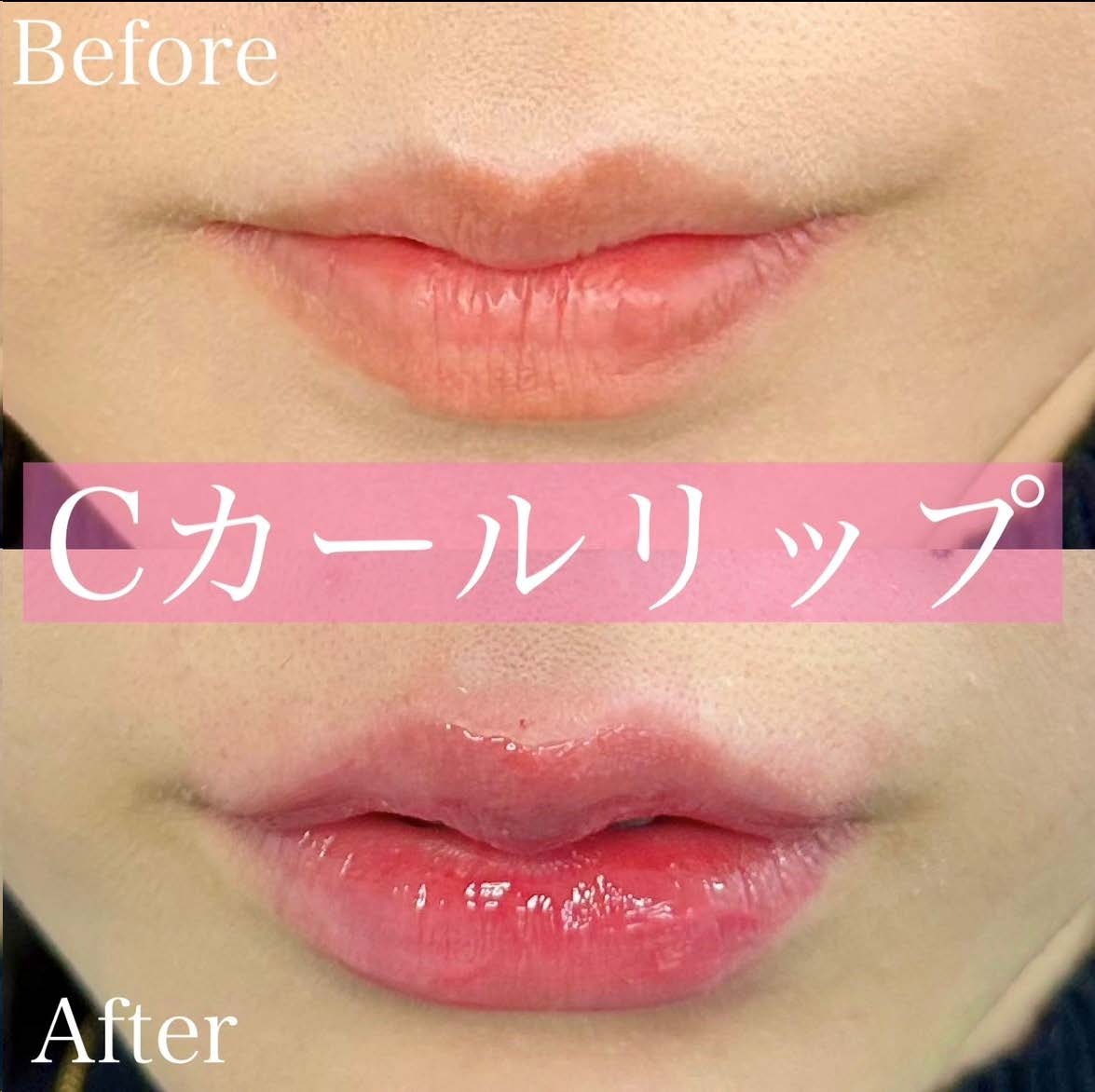 Cカールリップの症例写真