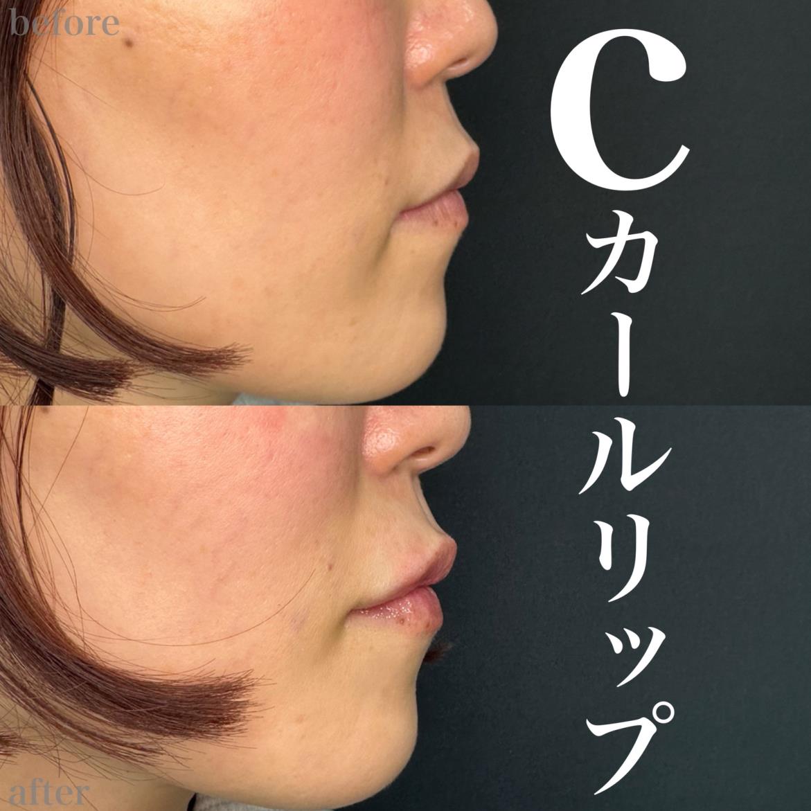 Cカールリップの症例写真