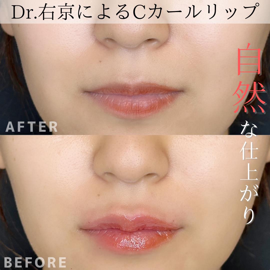 Cカールリップの症例写真