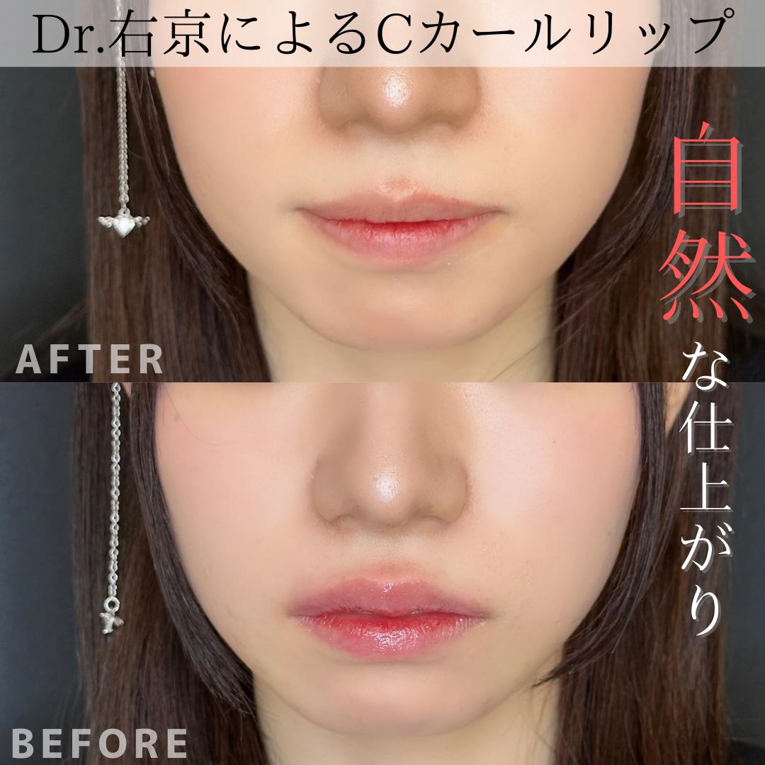 Cカールリップの症例写真