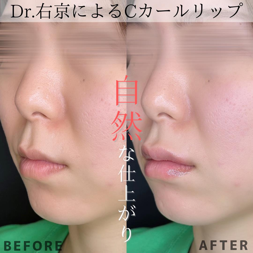 Cカールリップの症例写真