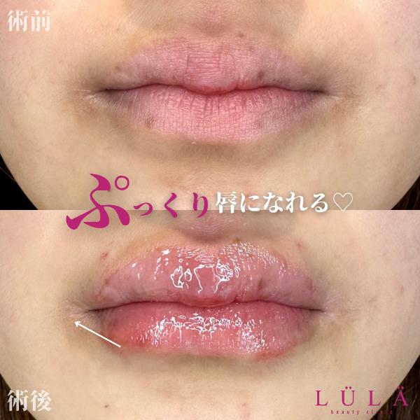 Cカールリップの症例写真