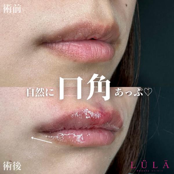 Cカールリップの症例写真