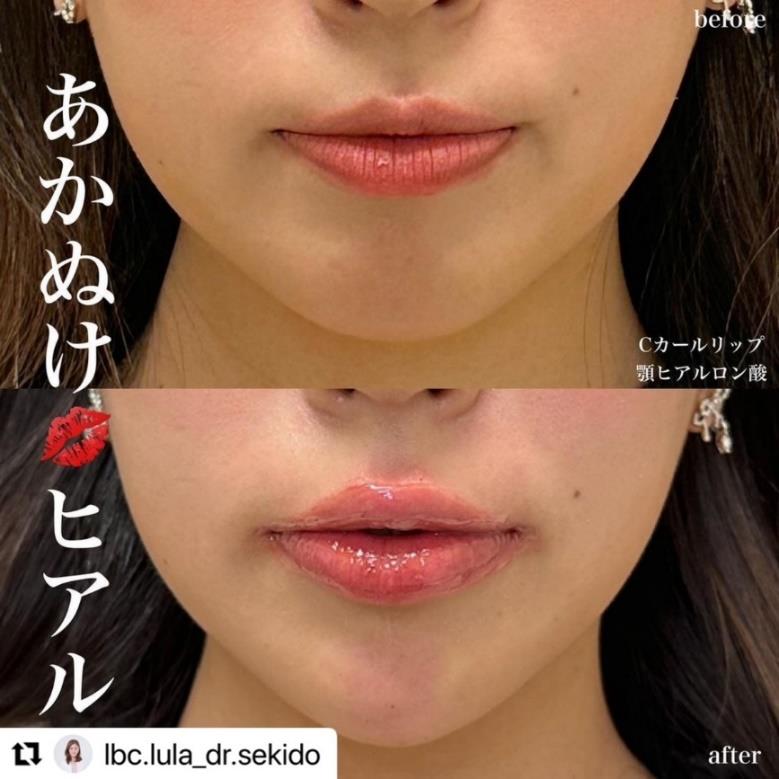 Cカールリップの症例写真