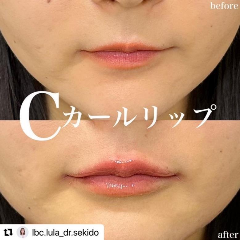 Cカールリップの症例写真