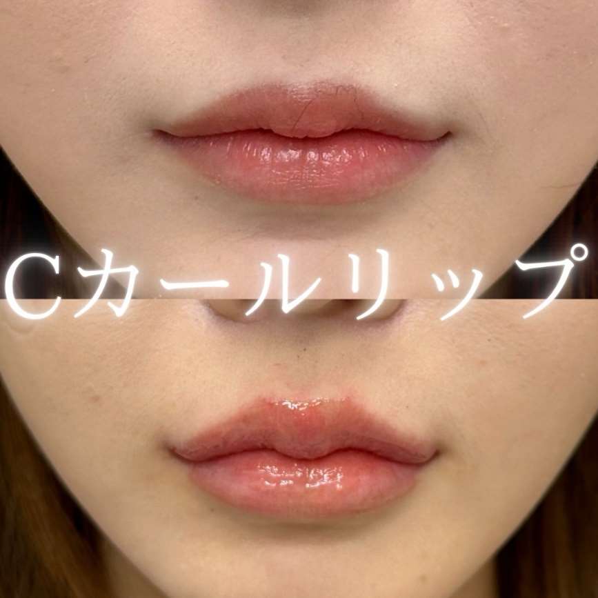 Cカールリップの症例写真