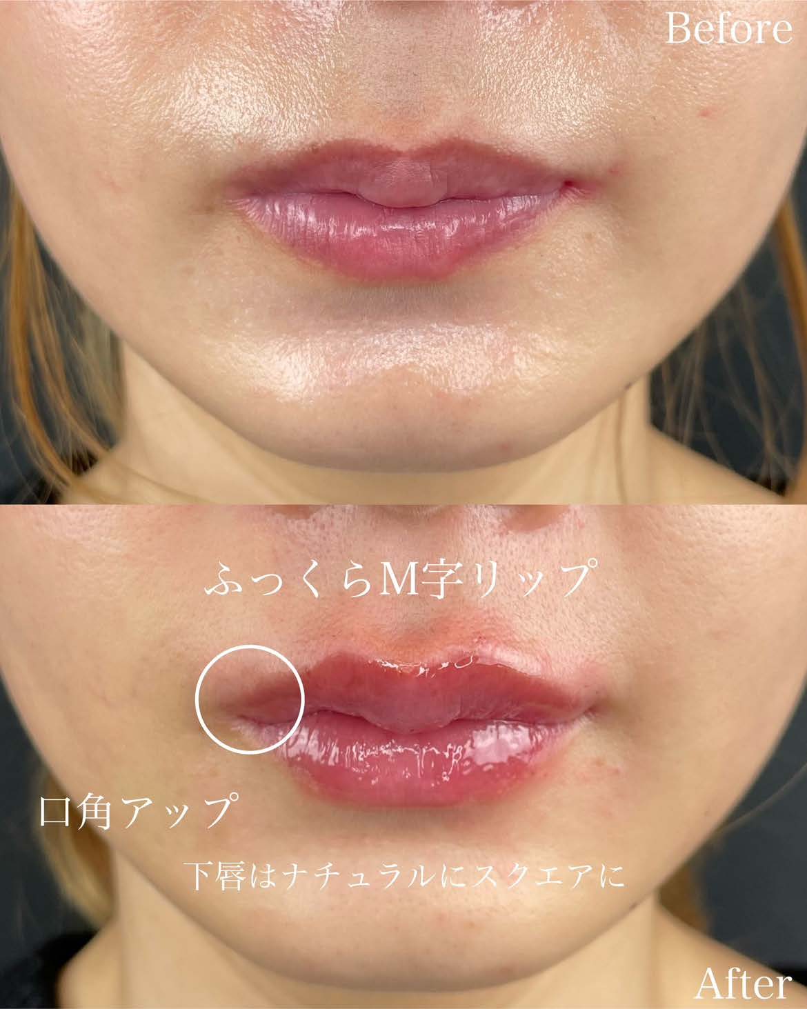 Cカールリップの症例写真