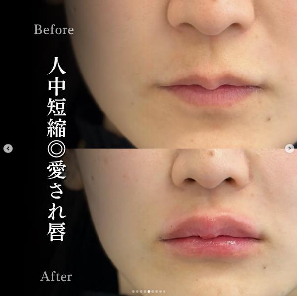 Cカールリップの症例写真