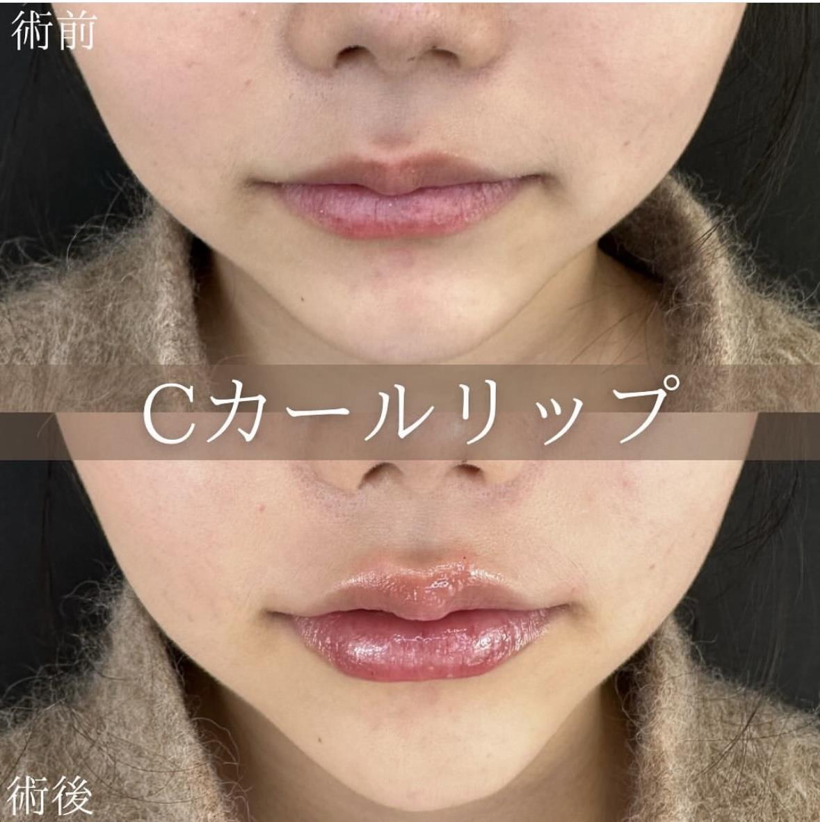 Cカールリップの症例写真