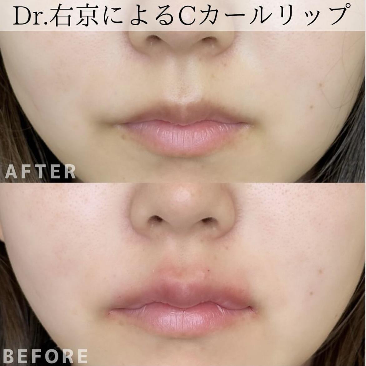 Cカールリップの症例写真