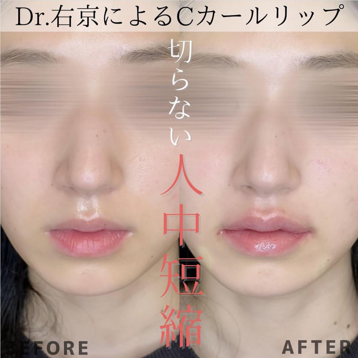 Cカールリップの症例写真