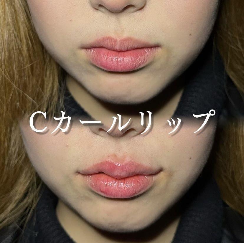 Cカールリップの症例写真