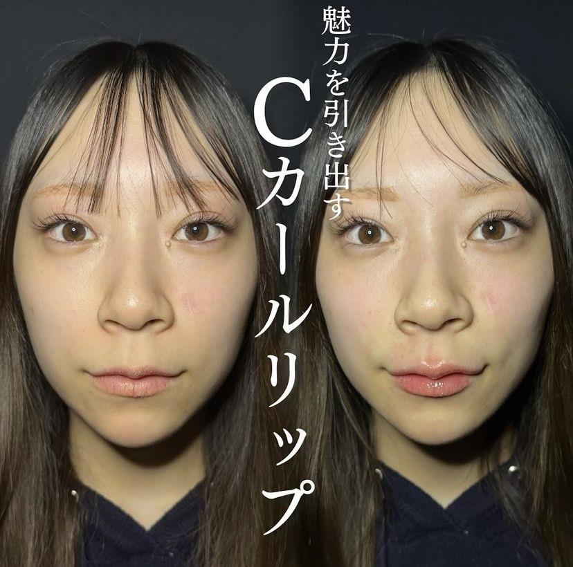 Cカールリップの症例写真