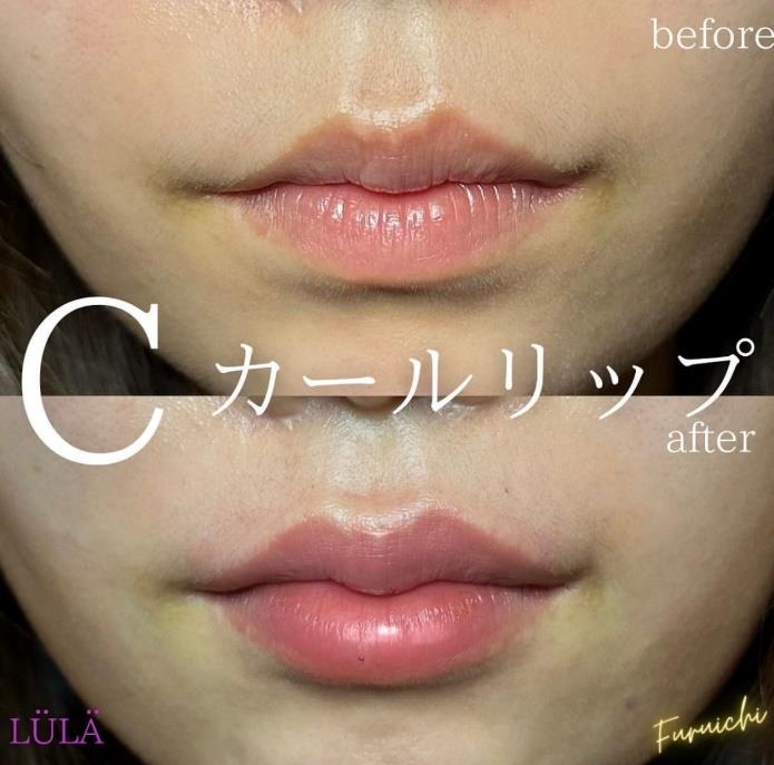 Cカールリップの症例写真